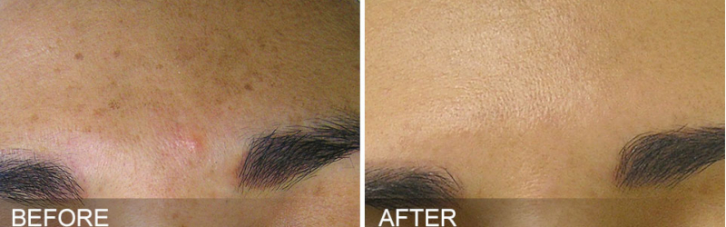 hydrafacial before and after