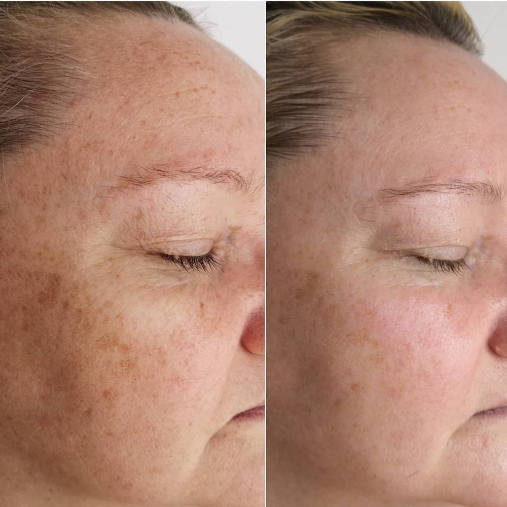 Flex MD Pigmentation