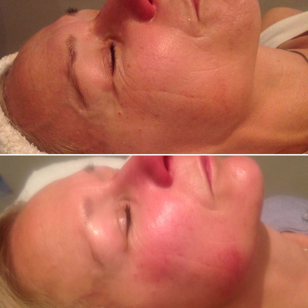 Skin Rejuvenation Before and Immediatley After-Dermalux and Skin Peel