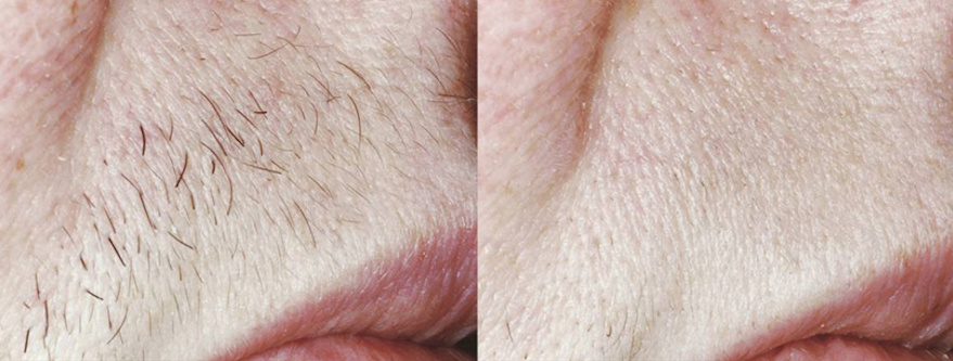 Laser Hair Before and After Laser hair removal