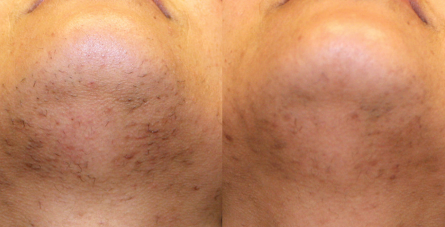 laser hair removal chin