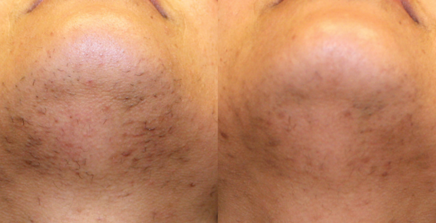 Laser Hair Before and After laser hair removal chin