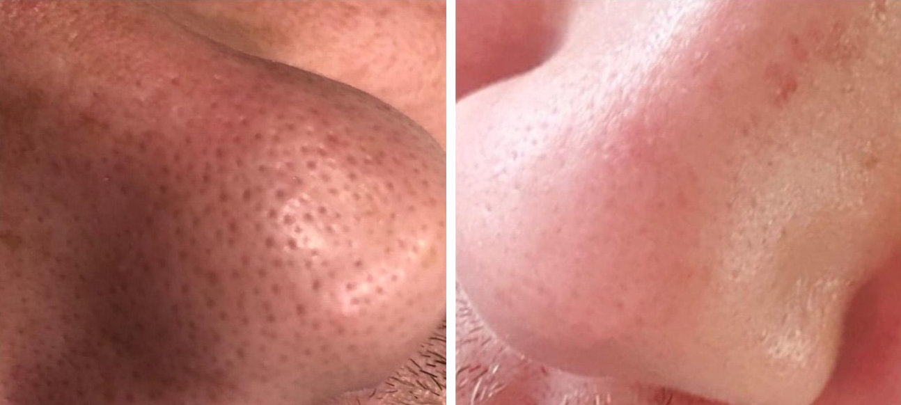 Micrneedling before and after