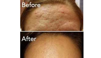 Before and after Vivace - Acne and Acne scaring