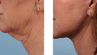 before-after-vivace3