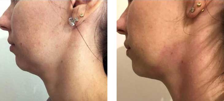 Before after RF Skin Tightening Before after RF Skin Tightening