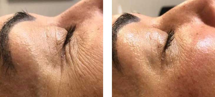 before-after-rf-skin-tightening2 Before and after Vivace - Acne and Acne scaring