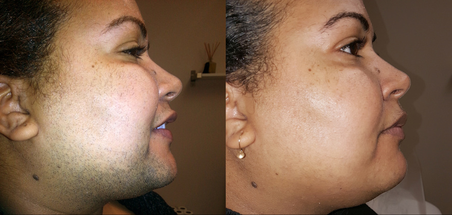Laser Hair Before and After Laser Hair Before and After
