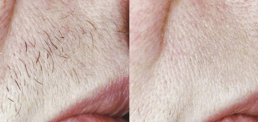 Laser Hair Before and After Laser Hair Before and After