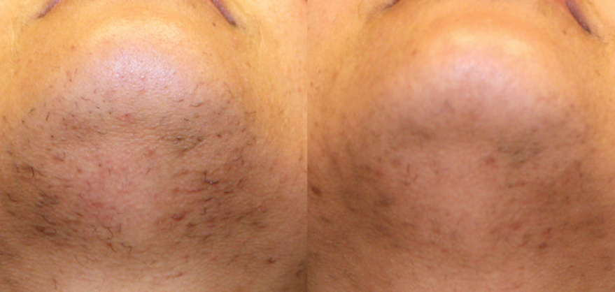 Laser Hair Before and After Laser Hair Before and After