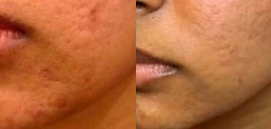 Microneedling Before and After