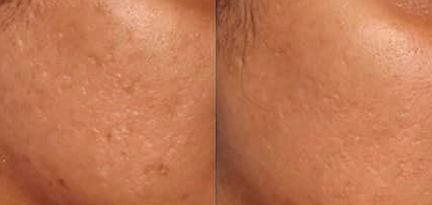 Microneedling Before and After